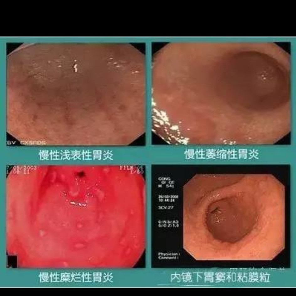 髀关穴治老胃病好吗,老胃病怎么治疗和调理