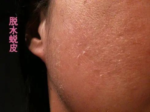 脸上角质层太薄如何养厚,红血丝角质层薄怎么增厚角质层