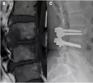 脊柱感染也可以微创治疗