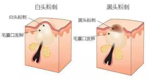 挤痘进了ICU，连下两次病危通知？这痘痘到底还能不能挤！