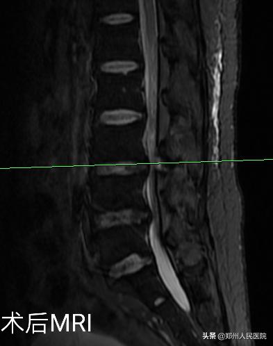 对骨科微创技术的认识,骨科手术与保守治疗对比