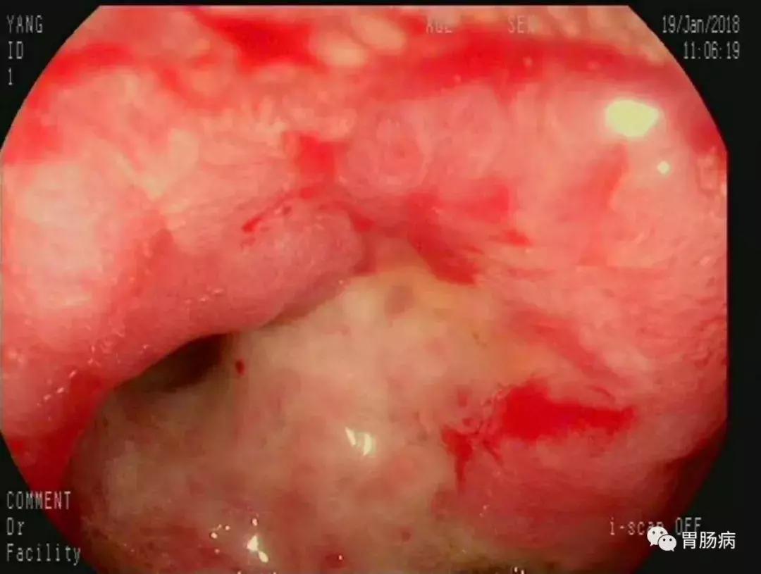 便血是直肠癌的早期吗,便血是直肠癌的前兆吗