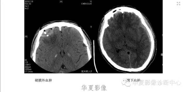 一文读懂颅内胆脂瘤,一文看懂背后的真相