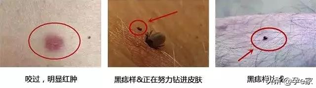 身上出现许多小黑痣,身上出现凸起黑痣一定要重视