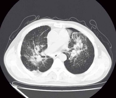 怀疑肺结核一定要查三次痰吗,医生怀疑是肺结核的几率有多大