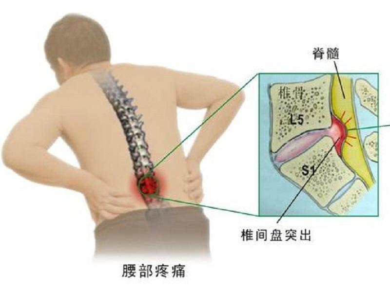 腰椎间盘突出脱出膨出的区别,腰椎间盘膨出和突出的中医治疗