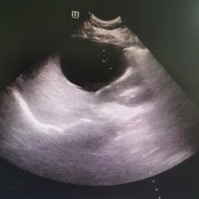 超声科治疗囊肿,肝囊肿超声引导下穿刺哪个医院好