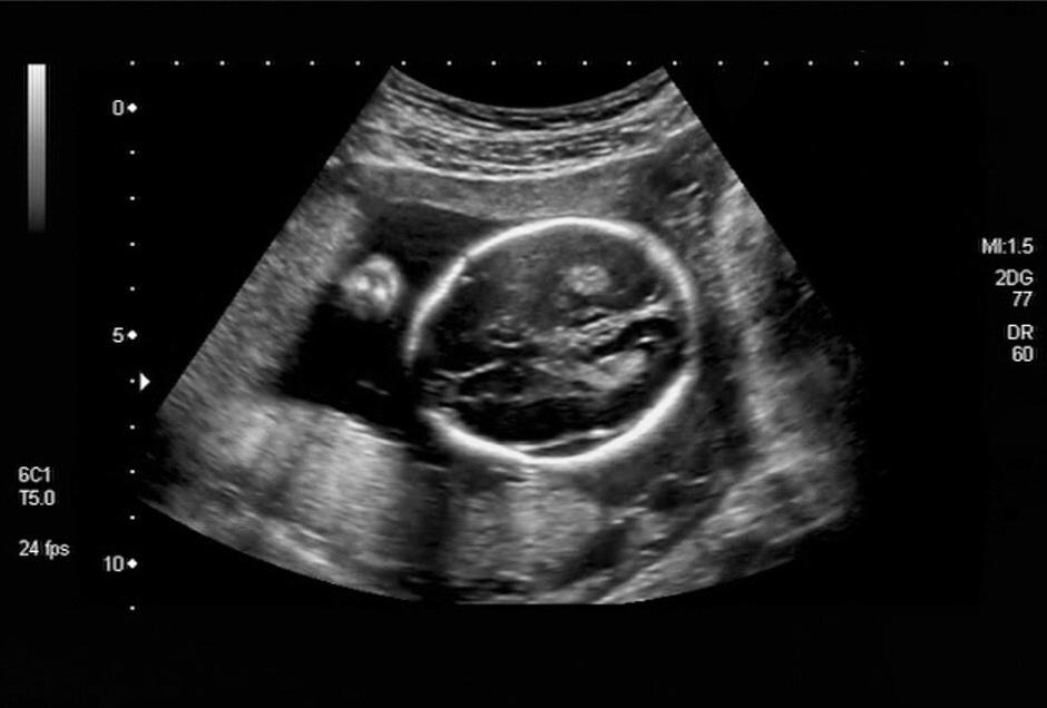 生化妊娠多久恢复排卵,生化妊娠多久可以自愈