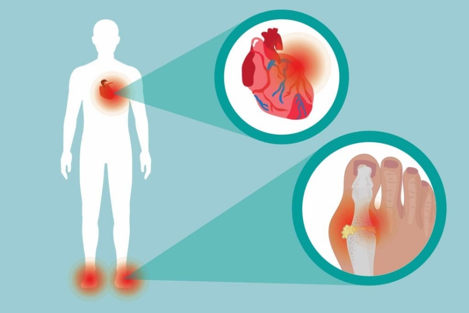 服用非布司他降尿酸，有哪些细节需要注意？有哪些可能的副作用？
