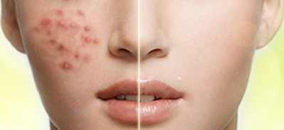 脾胃湿热引起的痘痘用什么,湿热生疮多吃什么才好