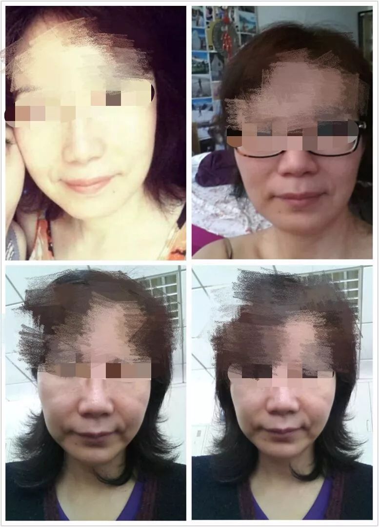 打瘦脸针毁容引起红肿眼睛看不见,女子被毁容后立即恢复