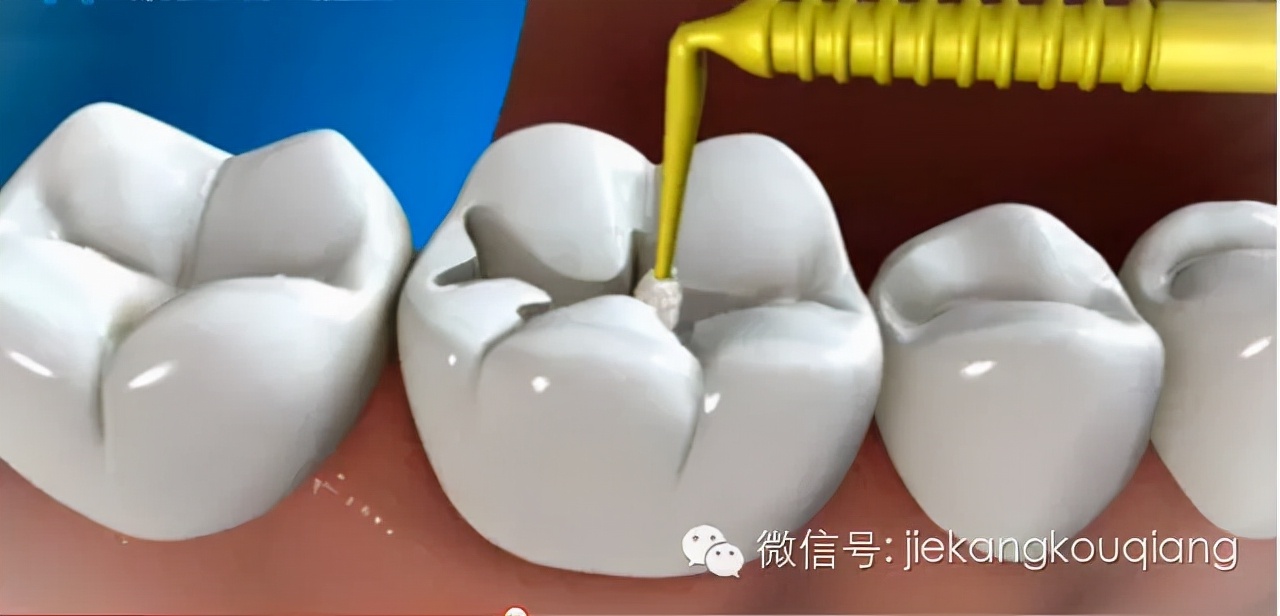 牙医一般都用什么材料补牙洞,牙医补牙全过程