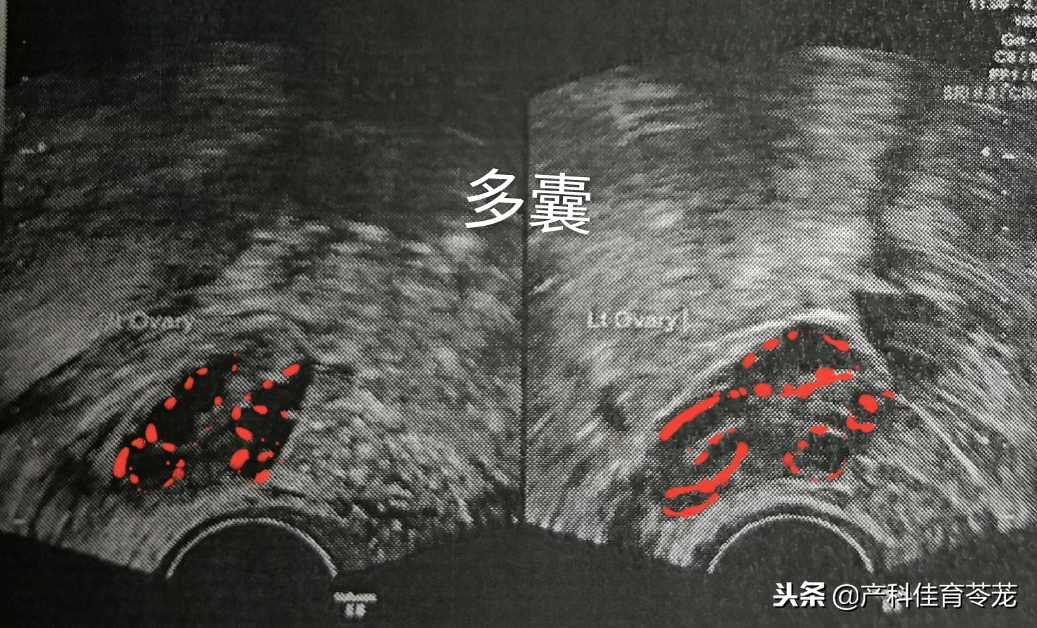 卵巢囊肿术后还有囊肿,卵巢囊肿是肿瘤性囊肿怎么治疗