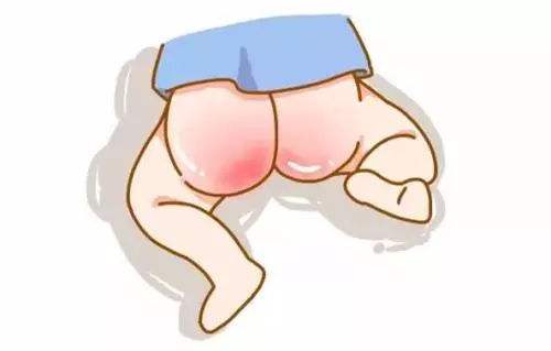 宝宝臀部肌肤怎么护理,宝宝臀部预防与护理技巧