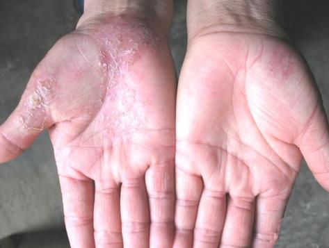 验方治愈一切真菌感染皮肤病,远离真菌