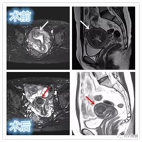 子宫腺肌病微创介入治疗时机