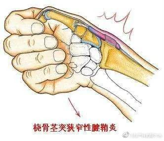 怎么用键盘不容易得腱鞘炎,键盘侠腱鞘炎