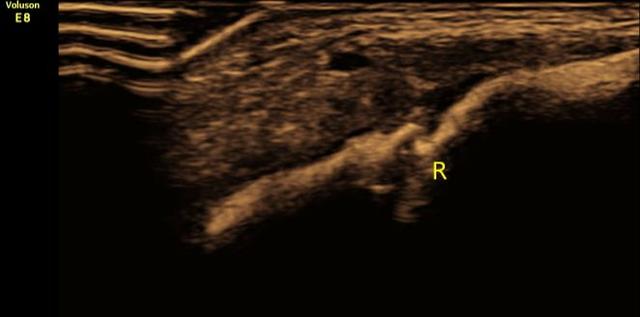 新生儿锁骨骨折医院一般怎么处理,新生儿锁骨骨折原因有哪些