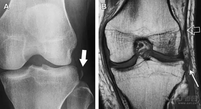 放射科夜班病例大全,放射科容易漏诊的骨折