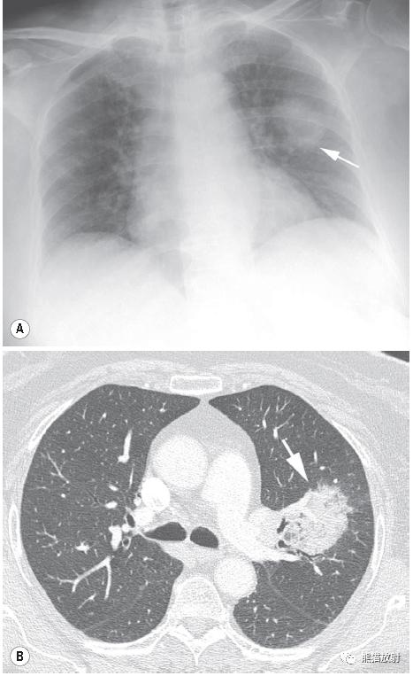 长期卧床病人肺部并发症,卧床患者肺部感染并发症