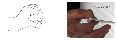 鎵嬮儴涓灑绁炵粡鍙楁崯浼氬紩璧锋墜楹诲悧,鎵嬮儴绁炵粡鍙楁崯鎵嬮夯鎬庝箞鍥炰簨