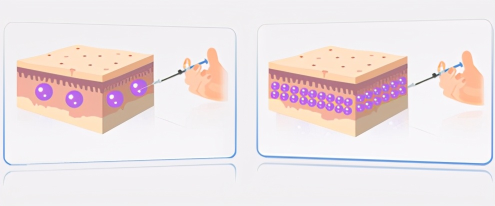 去眼袋术后出现细纹怎样修复,眼袋手术后细纹增加怎么办