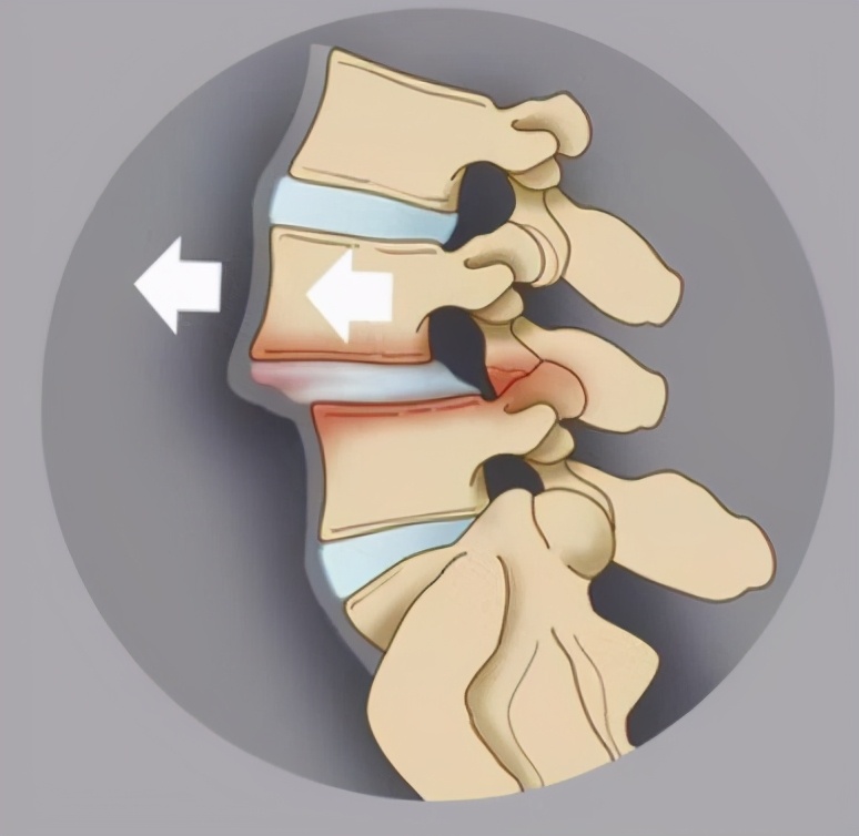 腰痛要警惕四种原因腰椎肿瘤,腰痛引起腰椎滑脱怎么治