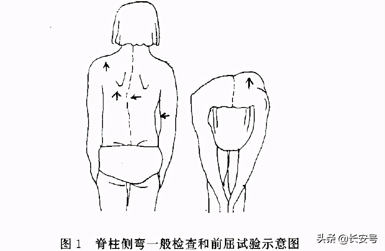 「医疗科普」关注儿童青少年脊柱侧弯