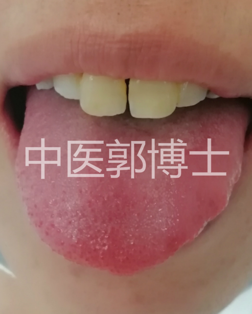 喜睡前加餐，脾肿大，血小板增多，但无不适感，服药后剥脱苔改善