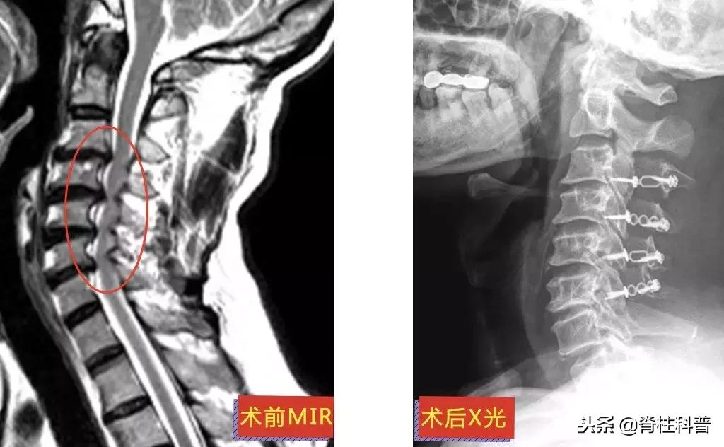 脊髓型颈椎病急刹车,严重颈椎病早期的10大症状