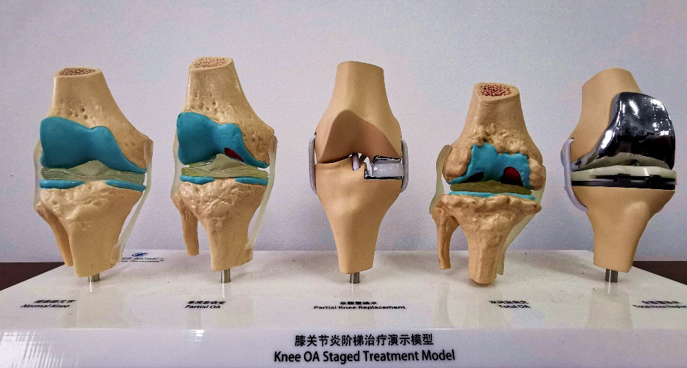 o型腿膝外侧关节疼痛,o型腿膝盖疼最好锻炼方法
