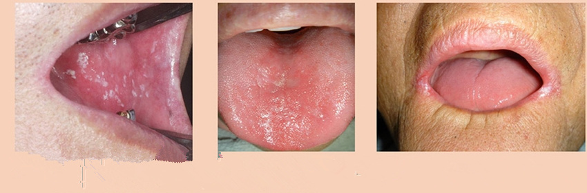 嘴巴上有小白点是怎么回事,有口腔白斑刷牙出血