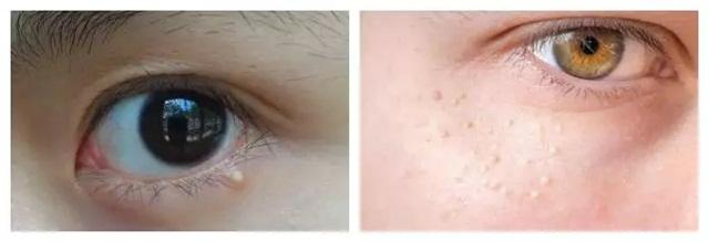 脸上频繁长脂肪粒怎么办,脸上长脂肪粒怎么办有效