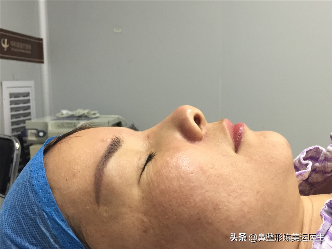 假体隆鼻后鼻子变歪该如何处理,假体隆鼻透光如何处理