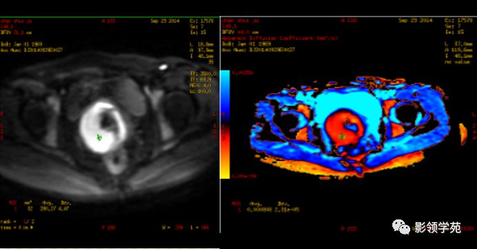 宫颈癌mri诊断,宫颈癌的mr扫描技术