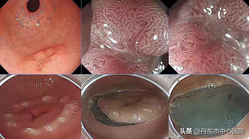 消化内镜中心治疗哪些病,消化内科内镜最新进展