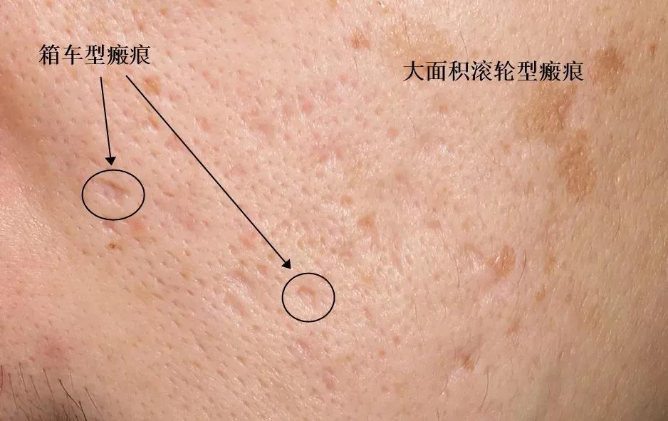 很多小痘坑修复好能和以前一样吗,顽固黑头痘坑