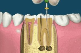 根管治疗后牙齿劈裂怎么办最好,牙齿戴冠还会劈裂