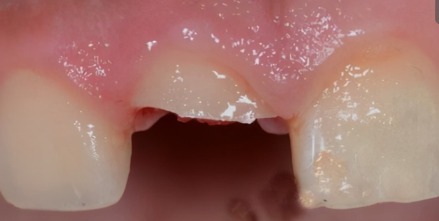 一颗牙齿缺失做种植好还是连冠好,缺失牙做连冠好还是活动义齿好