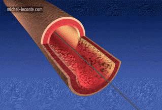 不想搭桥是否可以保守治疗,年轻人心梗支架与溶栓哪个好