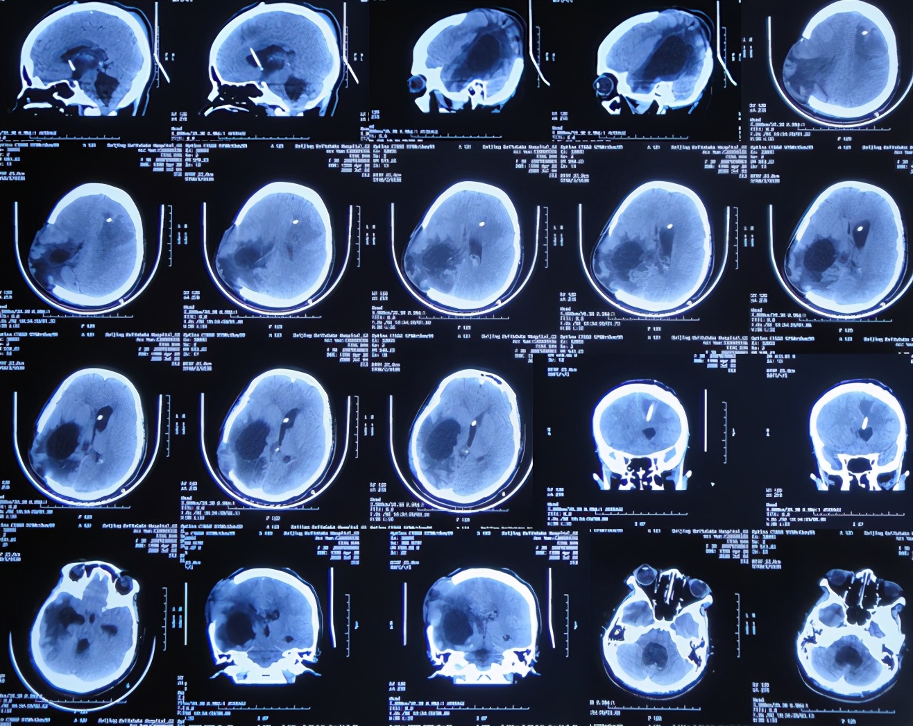 脑室有粘连脑积水有什么办法,脑动脉畸形手术后出现急性脑积水