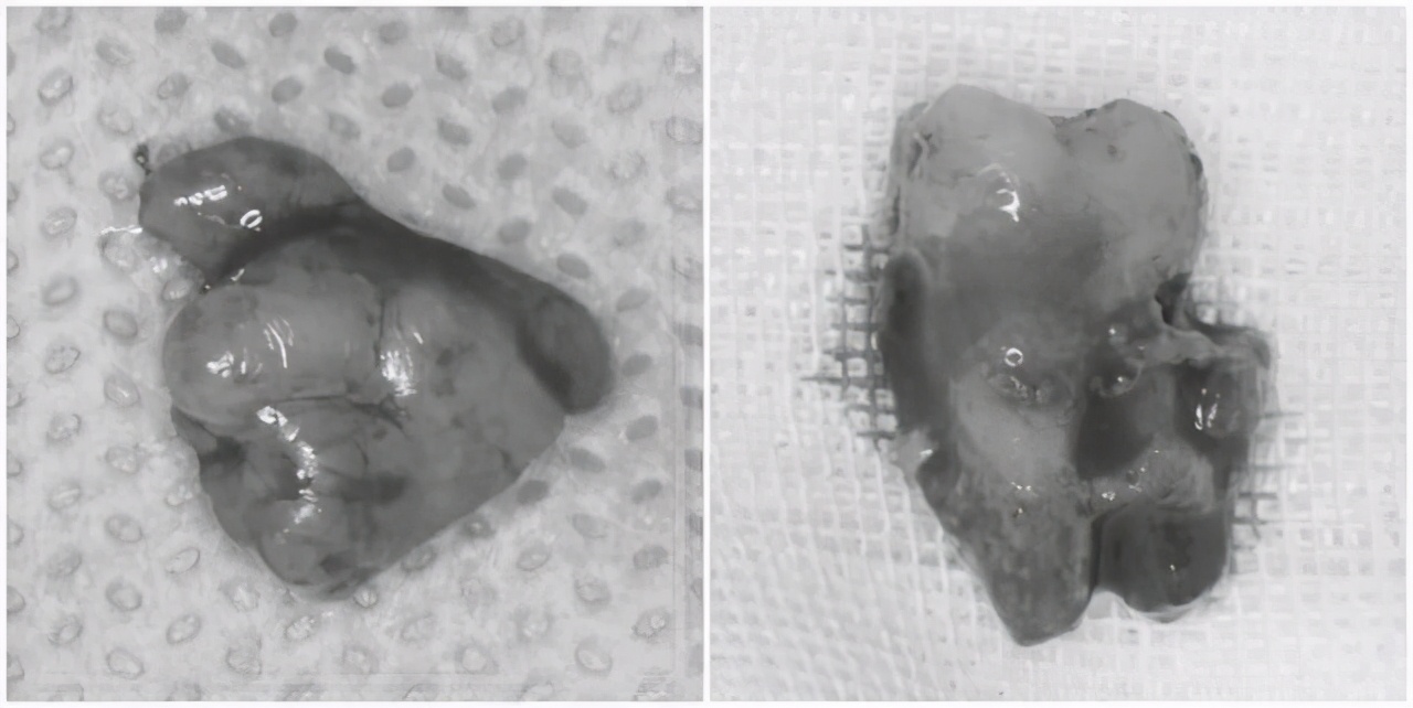牙龈长硬疙瘩不痛不痒的图片,牙龈疙瘩不痛不痒