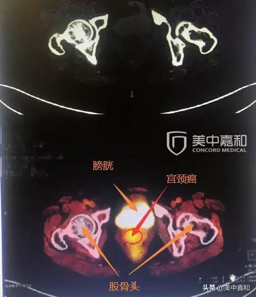 有哪些迹象表明肿瘤可能在恶化,癌症转移的10个症状