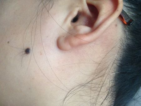 色素痣是手术去除还是激光去除好,色素痣怎么去掉