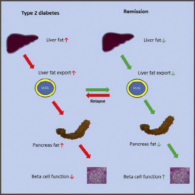 糖尿病消耗的是脂肪还是肌肉,糖尿病如何调养肝脏和胰腺