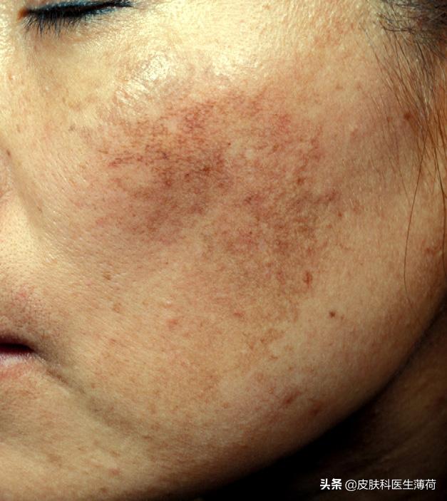 黄脸婆吃什么祛斑,告别黄脸婆自制纯中药祛斑面膜