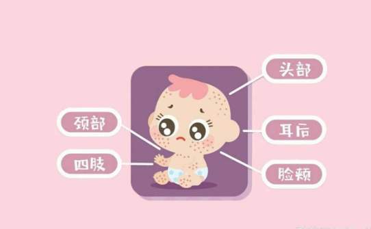 婴幼儿湿疹是什么原因造成的,婴幼儿湿疹是什么原因引起的