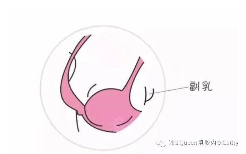 刚刚才长的副乳还很小怎么治疗,腋下有一个大大的副乳怎么办
