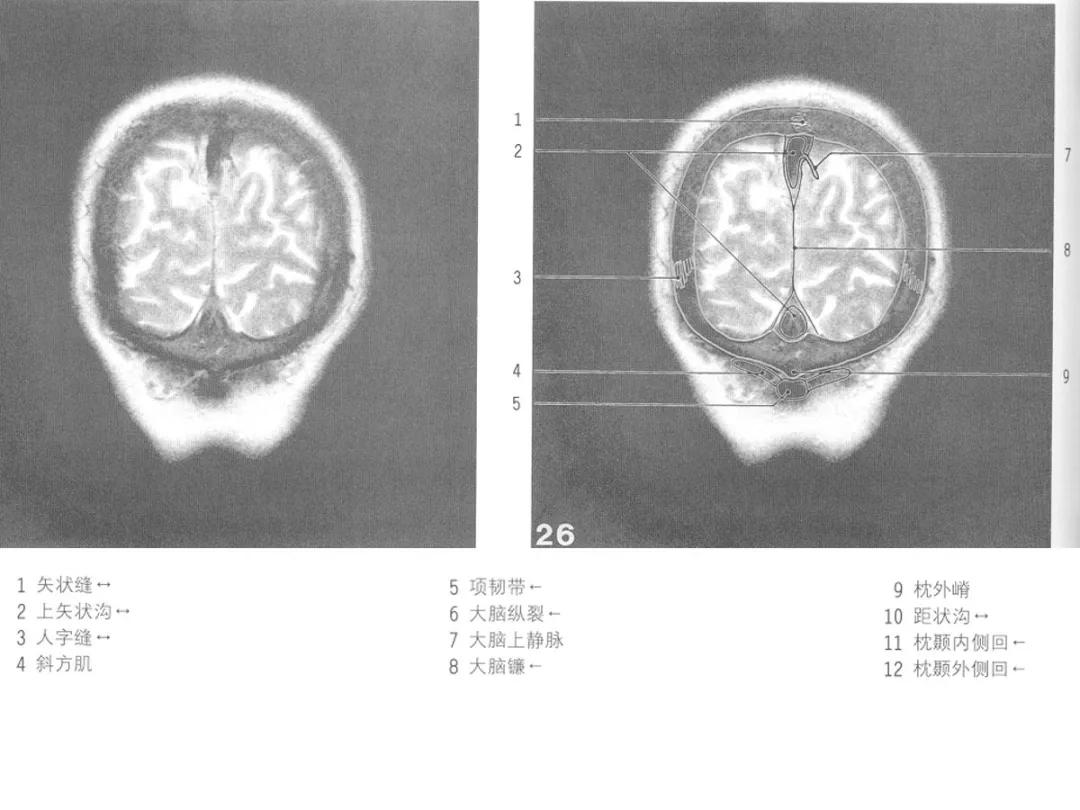 颅脑冠状状切面解剖图,颅脑mr解剖结构图