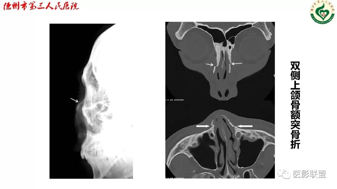 鼻骨骨折影像,鼻骨骨折dr影像表现